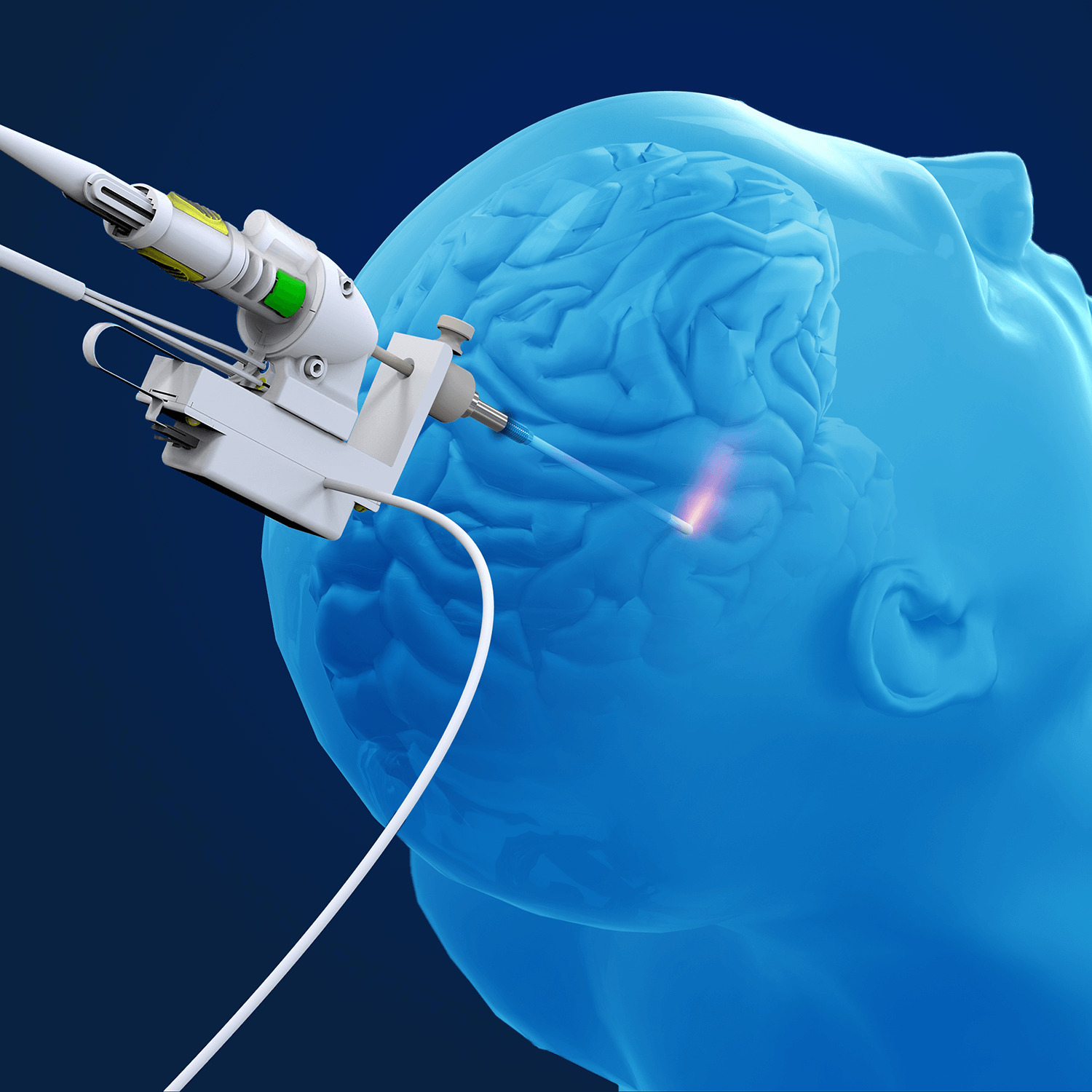 Monteris NeuroBlate System