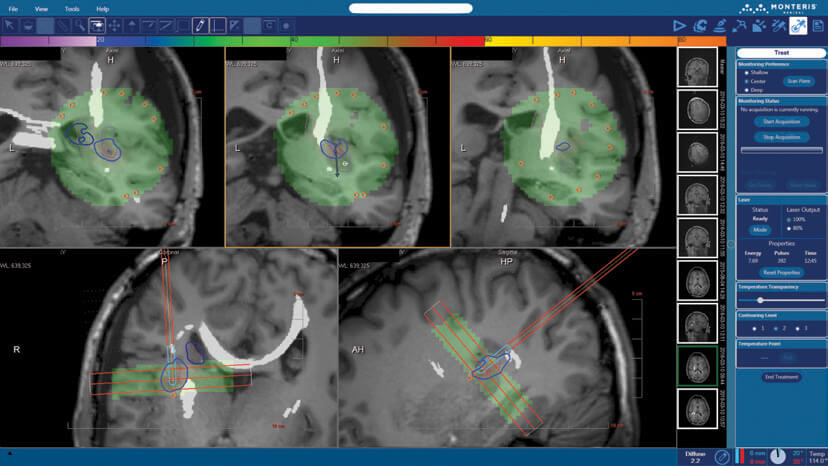 Enhanced visualization of the ablation target