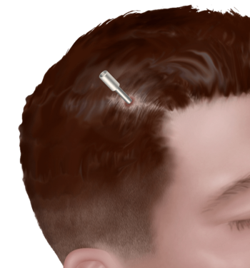 minimally-invasive-intra-op Minimally Invasive Intra-op