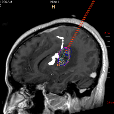 NeuroBlate Fusion Software